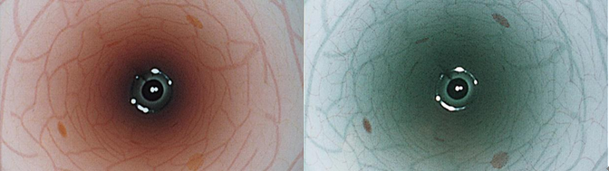 普通观察(左)图像强调观察(NBI)技术(右)