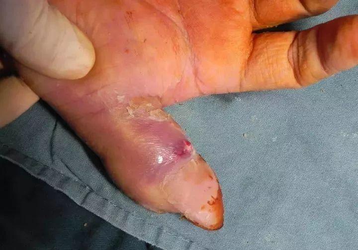 被同事咬了一口他差点要截指这嘴是真的有毒啊