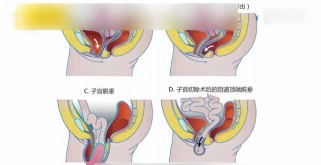 60岁大妈正跳着广场舞突然子宫掉了人都吓昏了