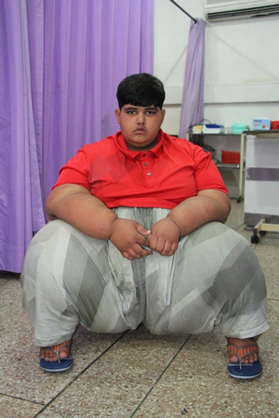 世界最胖男孩10岁近400斤 饭量相当于四个成人