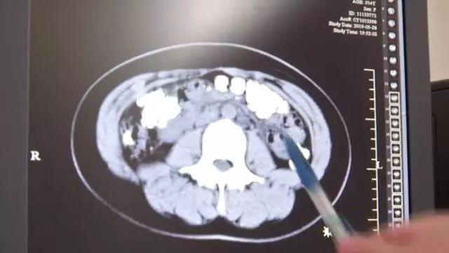 便血现象不容忽视:及时就医警惕痔疮等疾病