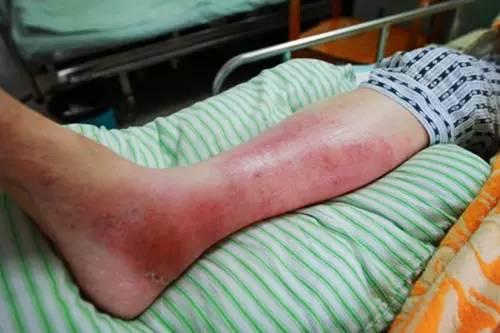 注意:男子街上蹚水,染上"丹毒",严重可致命