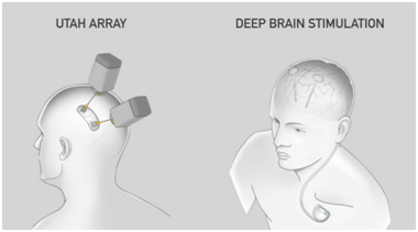 Neuralink欲在2020年投入人体临床试验 图片来源：Neuralink