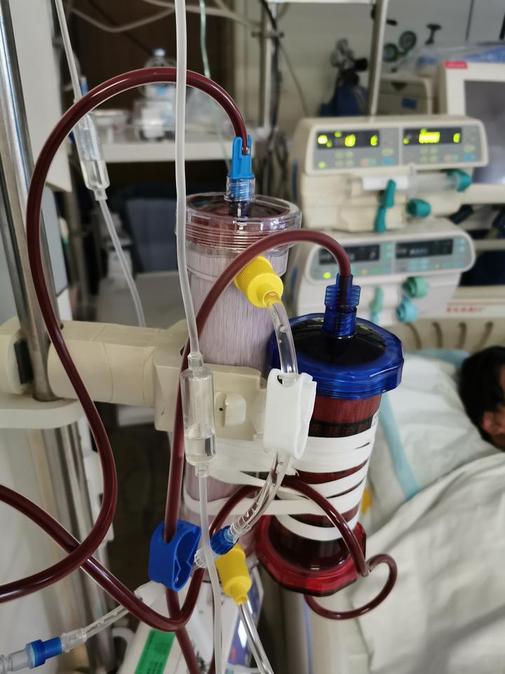 血液灌流加血液滤过治疗