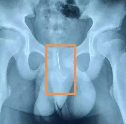 听儿子这么一说可把李女士吓了一大跳。问孩子是什么针,竟然是奶奶针灸治疗面瘫用的长针。