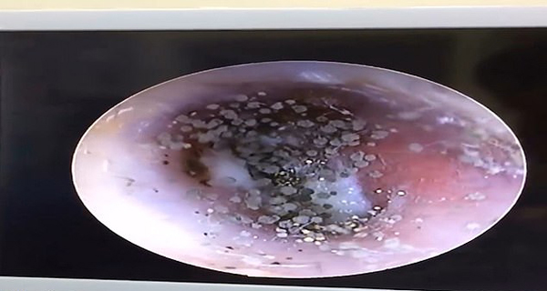 越南一女子耳朵又痛又痒耳内竟长出几十个 蘑菇