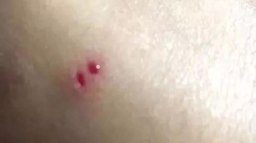 中秋前夜女子回家途中被竹叶青毒蛇咬中竟当场拍下照片自救