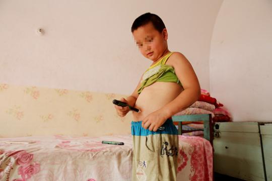 2016年8月2日，山西阳泉，一名9岁的1型糖尿病患者正在给自己注射胰岛素。