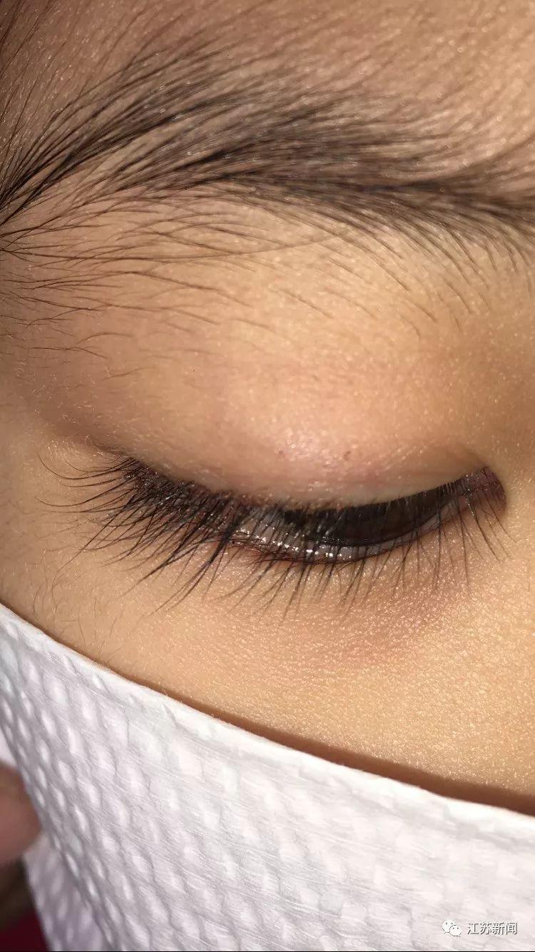 5岁女孩总揉眼睛，一检查取出20多只虱子…还在动！, image size:750x1334