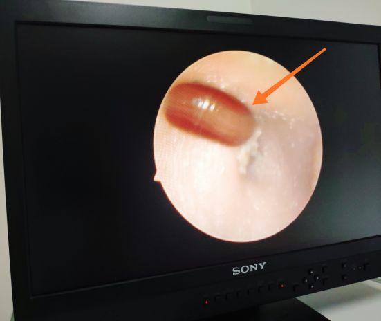 (耳内镜下,小星耳朵里的红豆)