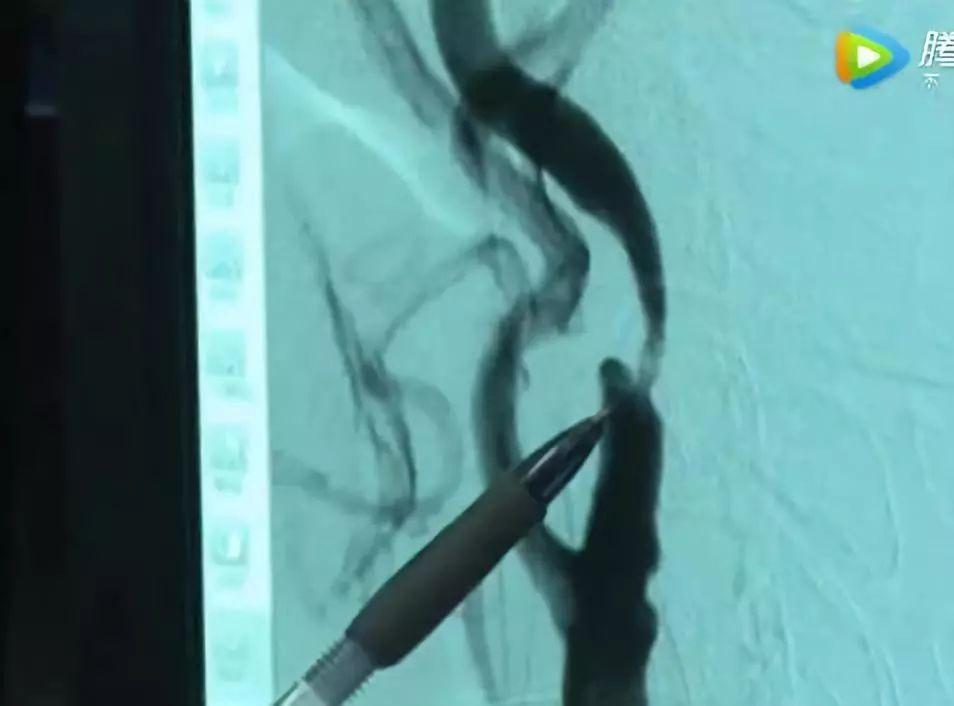 大叔体内掏出罕见“油脂” 医生一句话点醒所有人!