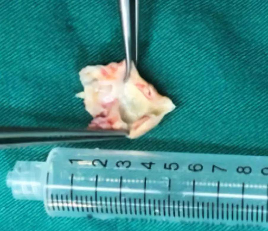 大叔体内掏出罕见“油脂” 医生一句话点醒所有人!