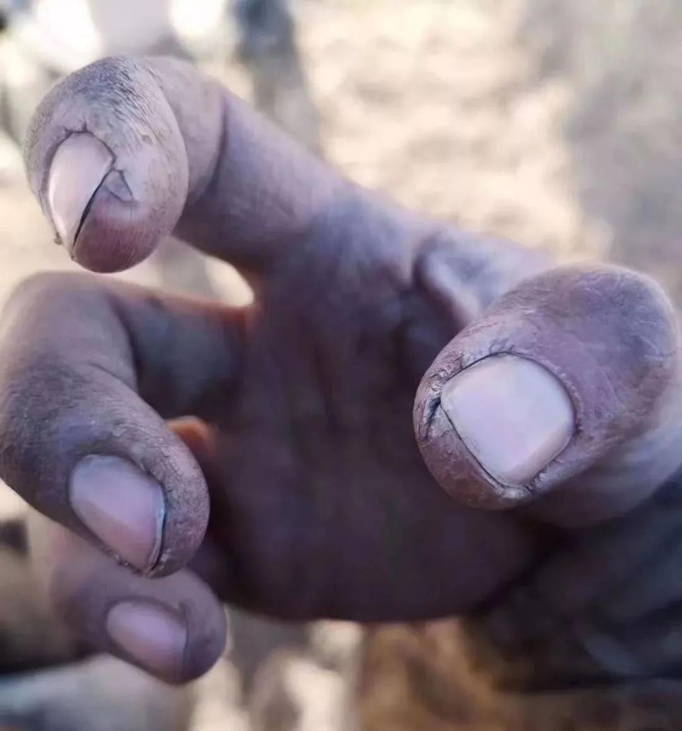 网友心疼的这双"握不住筷子的手",原来属于他和他们