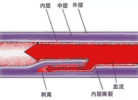 主动脉夹层示意图