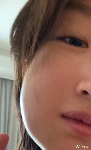"晒出的半张脸真的是肿到像在嘴里塞了鸡蛋一样,随后,有网友放出