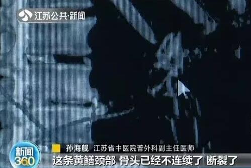 能治便秘?51岁男子生吞两条活黄鳝!CT里还能看见