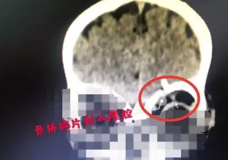 太恐怖了!因为一支铅笔,东莞1岁男童差点失明!