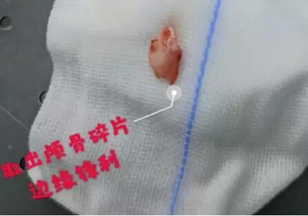 太恐怖了!因为一支铅笔,东莞1岁男童差点失明!